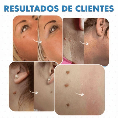 ByeWart® Adios a las Verrugas