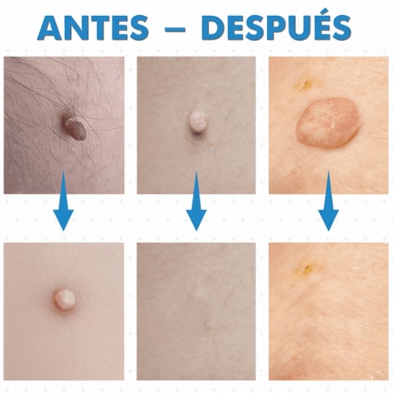 ByeWart® Adios a las Verrugas